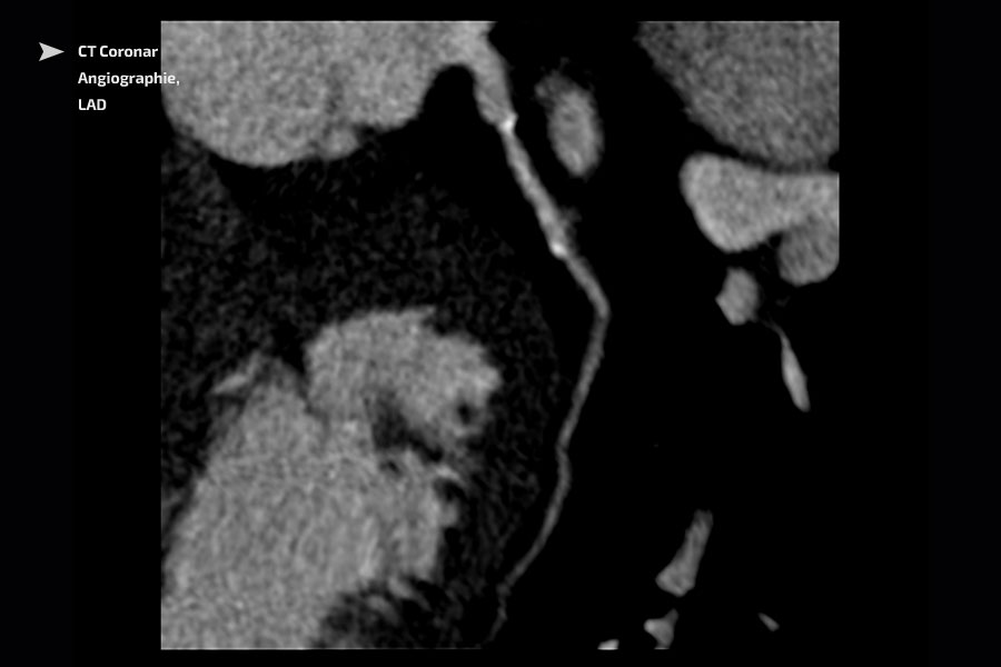 Filialpraxis Neuendettelsau - CT Coronar Angiograpie, LAD