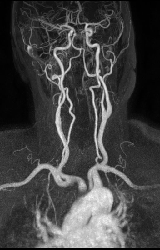 MR-Angiographie nach Gabe von KM i.v. (KM-MRA) der Kopf-Halsgefäße