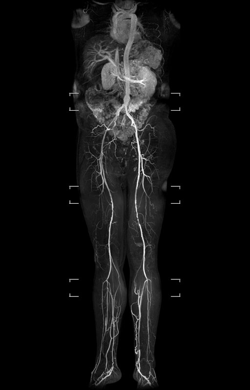 MR-Angiographie der Aorta thorakal und abdiminell und der Becken-Bein-Region
